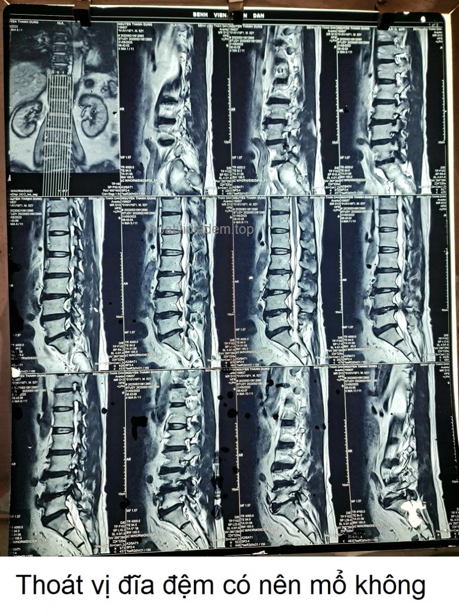 Thoát vị đĩa đệm có nên mổ không